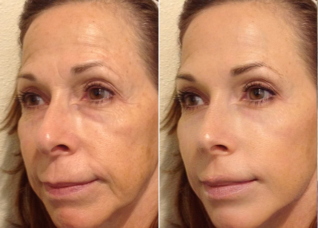 Microneedling Before & After